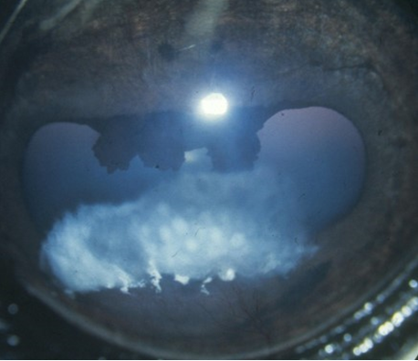 Kristallutfällningar vid kronisk uveit